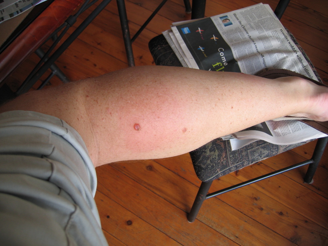 Infected leech bite